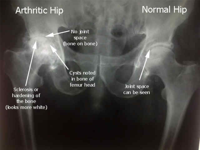 normal hip xray female